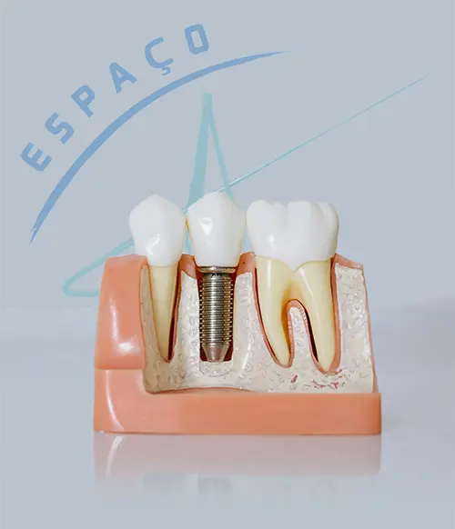 Paciente feliz com seu novo sorriso após o implante dentário.